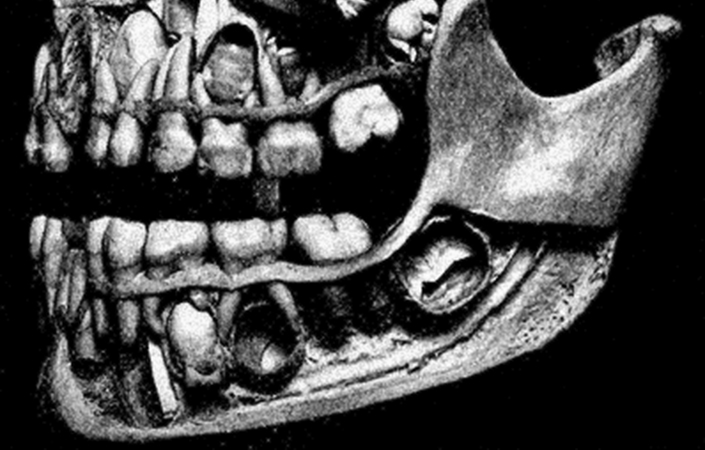 New study identifies limitations of human jaw to bite into hard foods ← ...