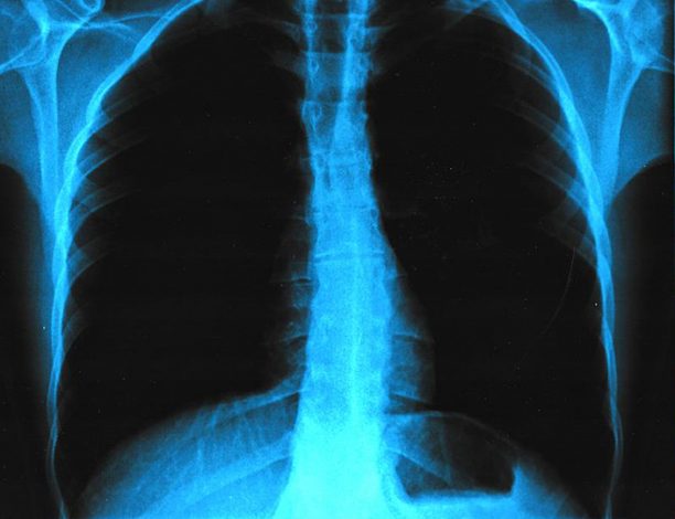 x-ray of health lungs in a human