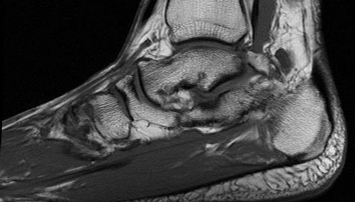 X-ray of damaged ankle