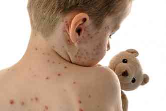 Measles: What factors are driving global decline in vaccinations?